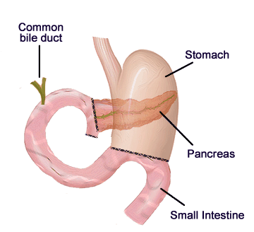 Whipple Surgery